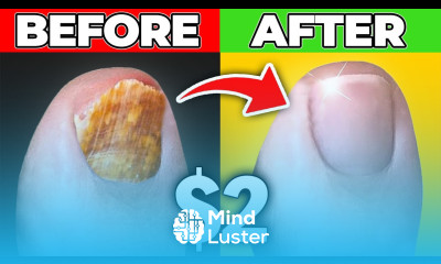 Get Rid Of Toenail Fungus for Good Dr Berg s 2 00 Cure