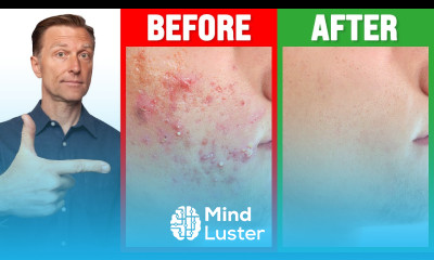 The FASTEST Way to Rid Acne Dr Berg