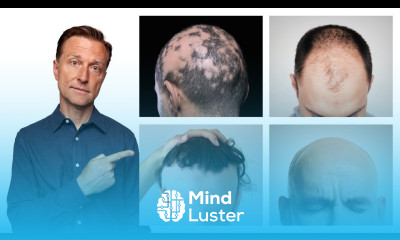 The 11 Types of Alopecia AND HOW TO FIX IT Dr Berg