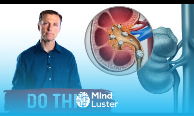 1st Sign of a Kidney Stone Do This – Kidney Stone Remedies – Dr Berg