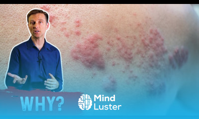 Post COVID 19 Vaccine Shingles