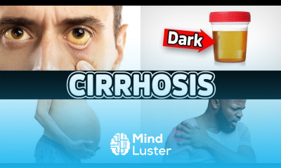 7 Warning Signs of Cirrhosis End Stage Liver Disease Dr Berg