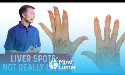 What Causes Liver Spots Age Spots – Dr Berg on Vitamin C Deficiency