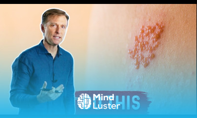 How to Deal With Ringworm Naturally