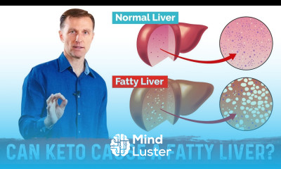 Can the Ketogenic Diet Cause a Fatty Liver Without Enough Vegetables – Dr Berg