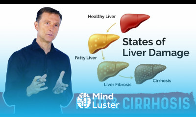 Why a Fatty Keto Ketogenic Diet Can Help Reverse a Fatty Liver – Dr Berg