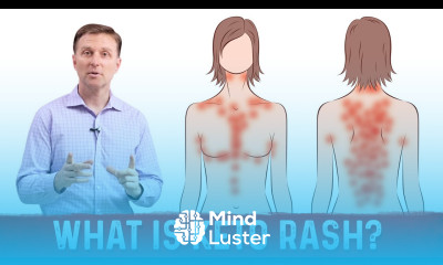 What is Keto Rash Dr Berg