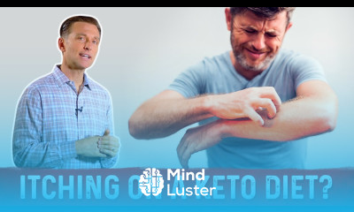 Are You Itching on a Ketogenic Diet – Dr Berg on Keto Rash