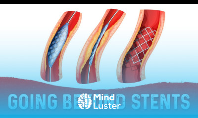Stents May be the Patch But Whats the Fix – Dr Berg