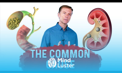 Gallstones vs Kidney Stones A Common Cause of Kidney Stones Gallstones – Dr Berg