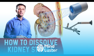 How To Dissolve Kidney Stones Explained By Dr Berg