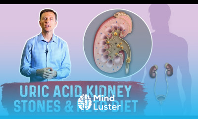 Uric Acid Kidney Stones Keto Diet – Dr Berg