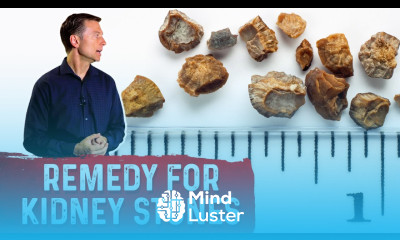 The Great Remedy to Prevent Kidney Stones – Dr Berg