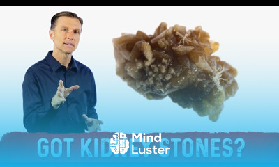 Treatment For Kidney Stone Kidney Stone Prevention – Dr Berg