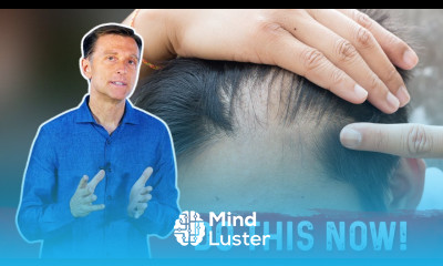 Receding Hairline Causes And Remedies – Dr Berg