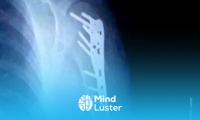 Dr Berg s follow up to his shoulder fracture