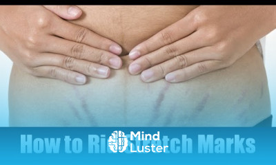 How to Rid Stretch Marks