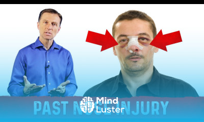 Post Nose Injury – Headache Pain Relief – Acupressure Techniques by Dr Berg