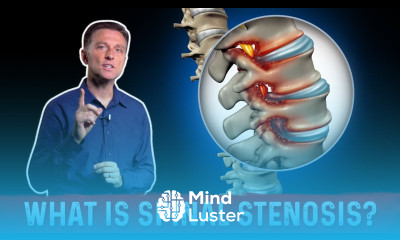 What is Spinal Stenosis And It s Causes Explained By Dr Berg