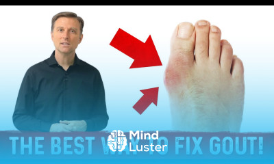 GOUT ARTHRITIS What Causes Gout and What Foods to Avoid for Gout