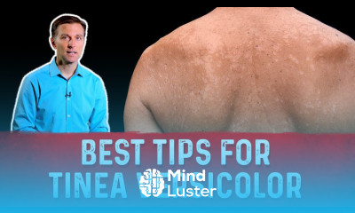 Best Tips for Tinea Versicolor Treatment Skin Fungus – Dr Berg