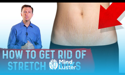 How To Get Rid of Stretch Marks After Pregnancy – Dr Berg