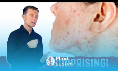 The Hidden Causes of Acne How to Get Rid of it – Dr Berg