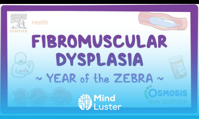 Fibromuscular dysplasia Year of the Zebra
