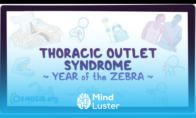 Thoracic outlet syndrome Year of the Zebra