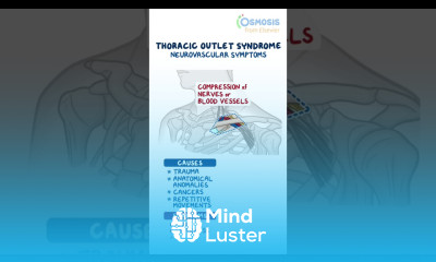 Thoracic Outlet Syndrome