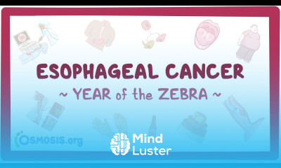 Esophageal Cancer Year of the Zebra