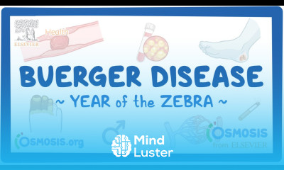 Buerger disease Year of the Zebra