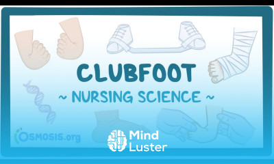 Clubfoot Clinical Nursing Care