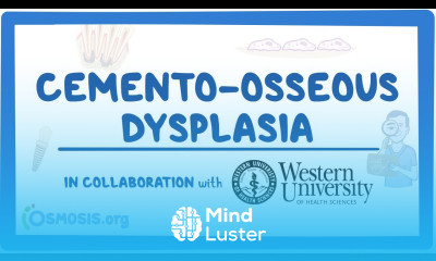 Cemento osseous Dysplasia in Collaboration w Western University