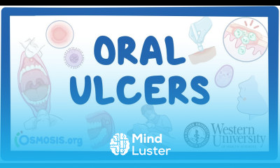 Western University Oral Ulcers