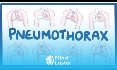 Pneumothorax causes symptoms diagnosis treatment pathology