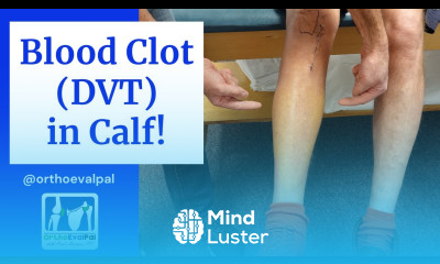 Blood Clot DVT in the Calf Actual Patient Presentation