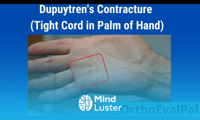 Dupuytren s Contracture Tight Cord in Palm of Hand