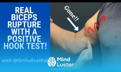 Biceps Rupture with a Positive Hook Test