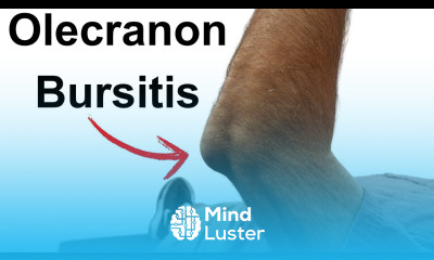 Olecranon Bursitis