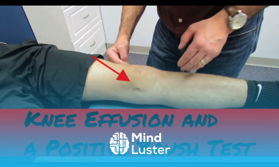 Knee effusion positive brush test and intra articular knee injury eval