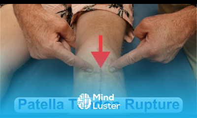 Patella Tendon Rupture Evaluation