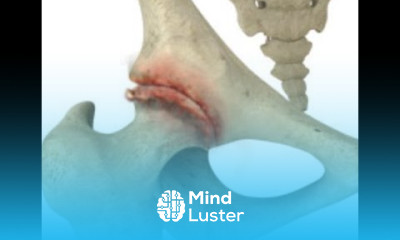 Podcast Episode 85 3 Most Common Signs of Hip Arthritis