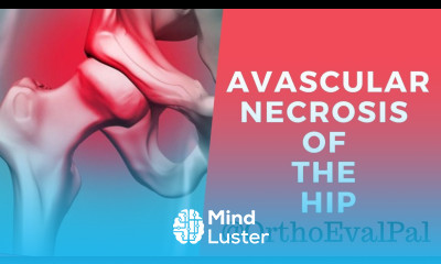 Avascular Necrosis of the Hip Explained by Paul at Ortho Eval Pal