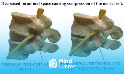 Lumbar Spinal Stenosis Webinar