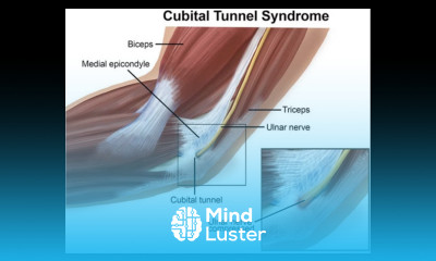 Learn Episode 77 Cubital tunnel syndrome - Mind Luster