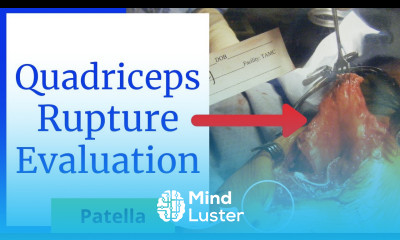 Quadriceps Rupture Evaluation Acute Tear