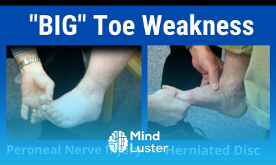 Big Toe Weakness Peroneal Nerve Palsy vs L5 Nerve Root Compression