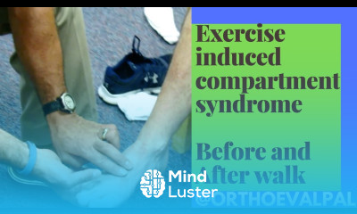 Exercise Induced Compartment Syndrome Signs and Symptoms