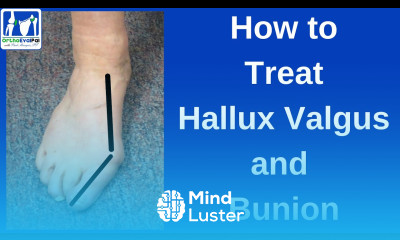 How to Treat Hallux Valgus and Bunion